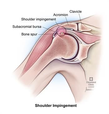 Shoulder Impingement
